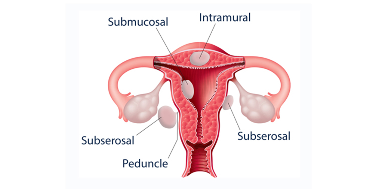 Ovarian Cyst Treatment at Phular IVF