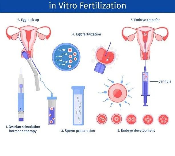 IVF Treatment