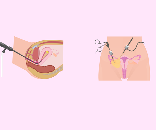 Hysteroscopy & Laparoscopy at Phular IVF